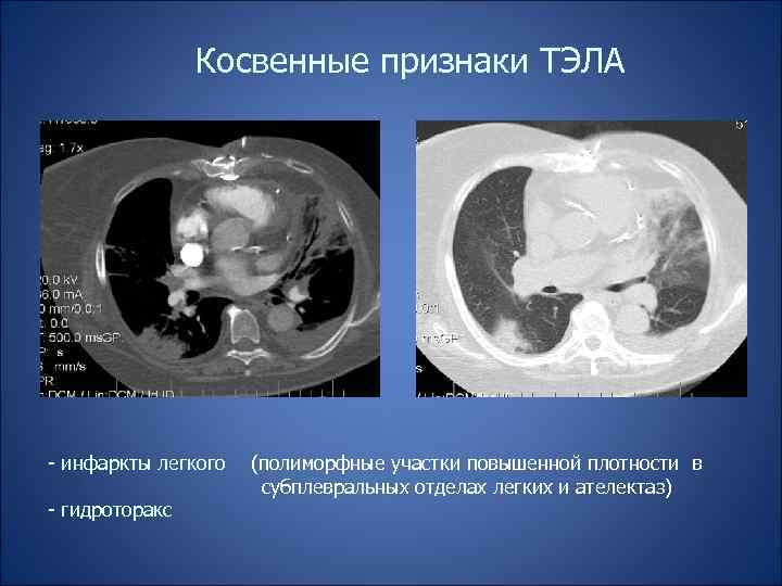 Косвенные признаки ТЭЛА - инфаркты легкого - гидроторакс (полиморфные участки повышенной плотности в субплевральных