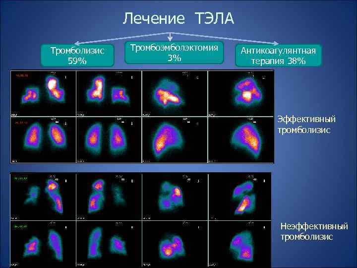 Лечение ТЭЛА Тромболизис 59% Тромбоэмболэктомия 3% Антикоагулянтная терапия 38% Эффективный тромболизис Неэффективный тромболизис 