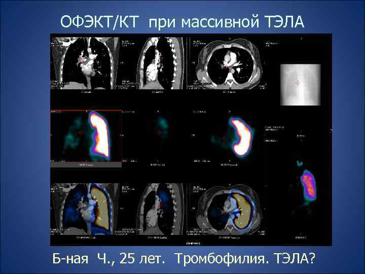 ОФЭКТ/КТ при массивной ТЭЛА Б-ная Ч. , 25 лет. Тромбофилия. ТЭЛА? 