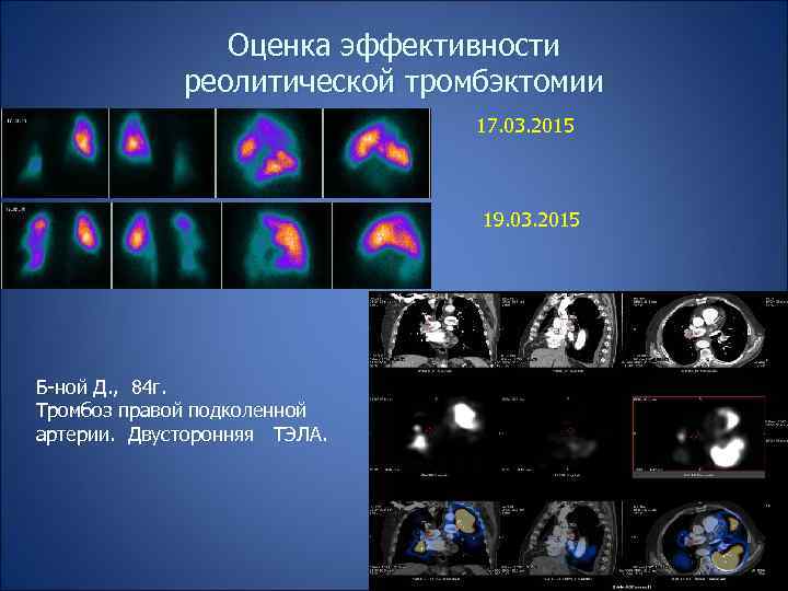 Оценка эффективности реолитической тромбэктомии 17. 03. 2015 19. 03. 2015 Б-ной Д. , 84