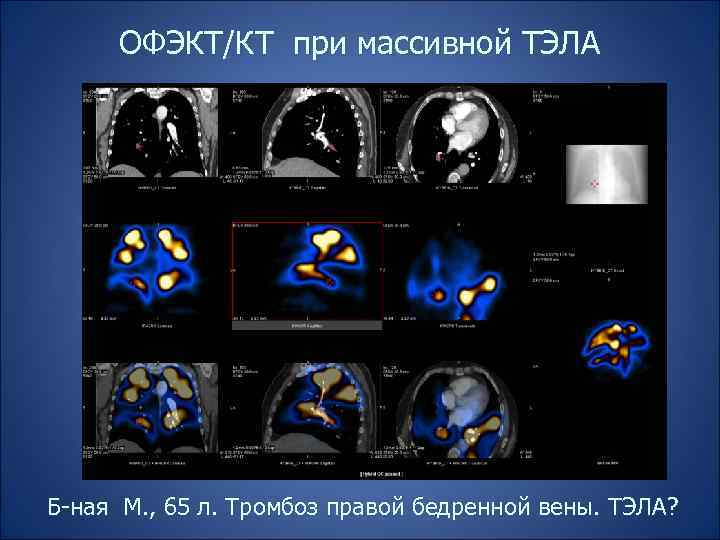 ОФЭКТ/КТ при массивной ТЭЛА Б-ная М. , 65 л. Тромбоз правой бедренной вены. ТЭЛА?