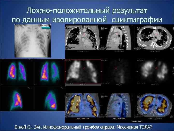 Ложно-положительный результат по данным изолированной сцинтиграфии Б-ной С. , 34 г. Илиофеморальный тромбоз справа.