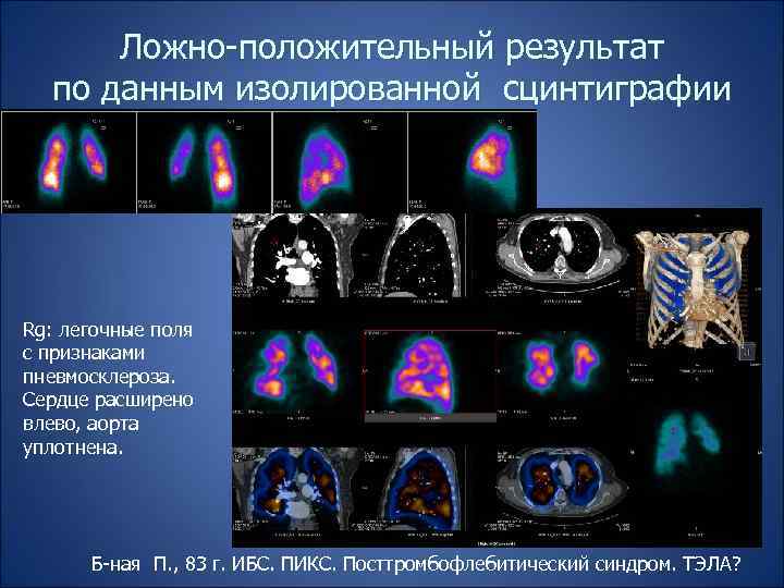 Ложно-положительный результат по данным изолированной сцинтиграфии Rg: легочные поля с признаками пневмосклероза. Сердце расширено