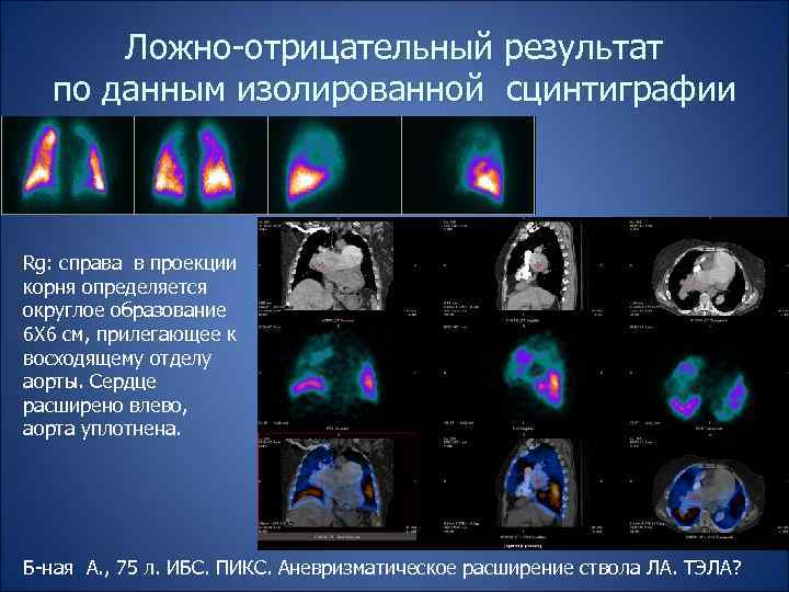 Ложно-отрицательный результат по данным изолированной сцинтиграфии Rg: справа в проекции корня определяется округлое образование