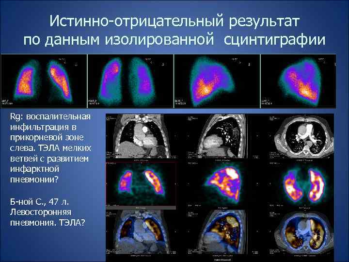 Истинно-отрицательный результат по данным изолированной сцинтиграфии Rg: воспалительная инфильтрация в прикорневой зоне слева. ТЭЛА