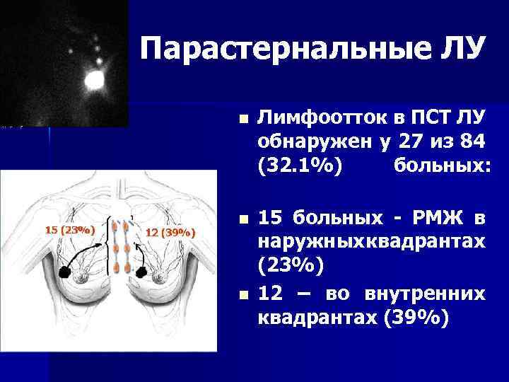 Парастернальные ЛУ n Лимфоотток в ПСТ ЛУ обнаружен у 27 из 84 (32. 1%)