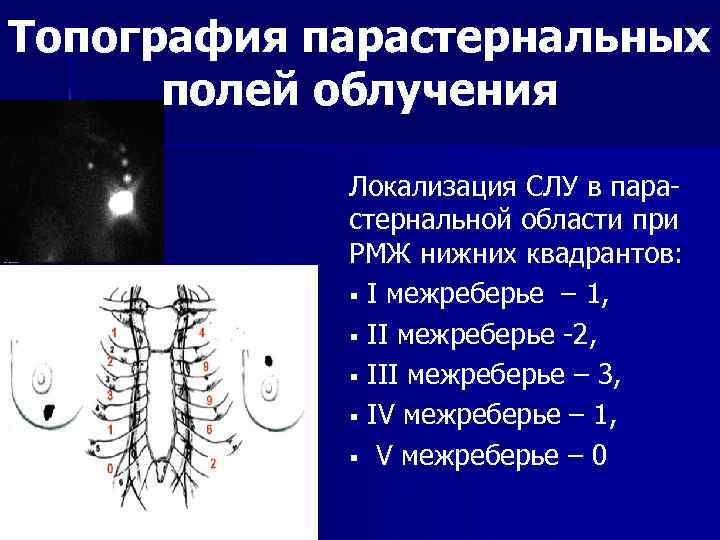 Топография парастернальных полей облучения Локализация СЛУ в парастернальной области при РМЖ нижних квадрантов: §