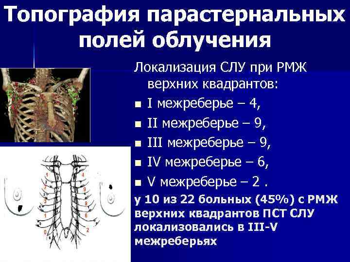 Топография парастернальных полей облучения Локализация СЛУ при РМЖ верхних квадрантов: n I межреберье –