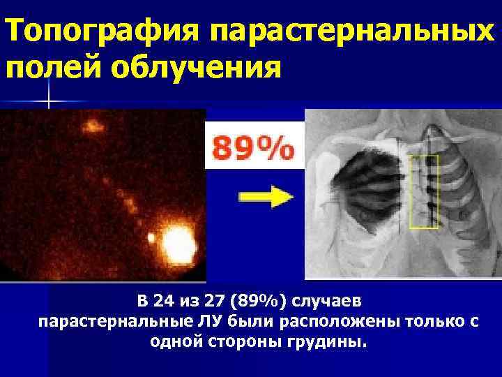 Топография парастернальных полей облучения В 24 из 27 (89%) случаев парастернальные ЛУ были расположены