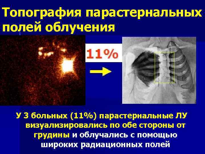 Топография парастернальных полей облучения У 3 больных (11%) парастернальные ЛУ визуализировались по обе стороны