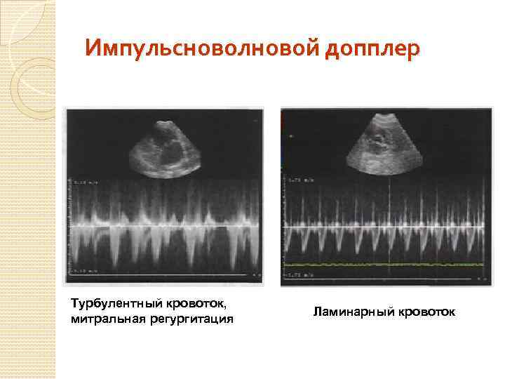 Импульсноволновой допплер Турбулентный кровоток, митральная регургитация Ламинарный кровоток 
