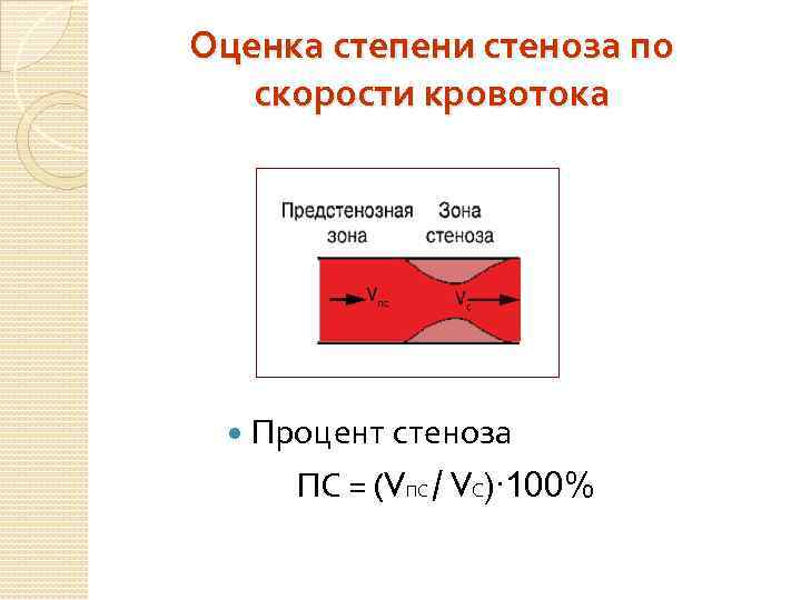 Оценка степени стеноза по скорости кровотока Процент стеноза ПС = (VПС / VС)∙ 100%
