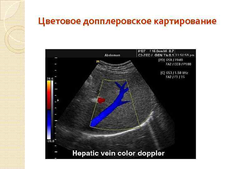 Цветовое допплеровское картирование 