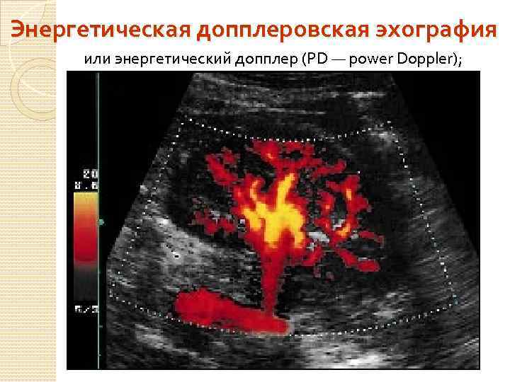 Энергетическая допплеровская эхография или энергетический допплер (PD — power Doppler); 