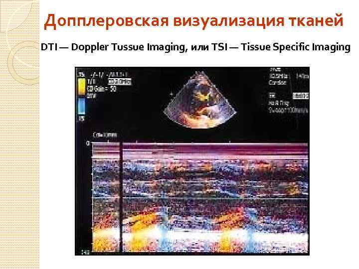 Допплеровская визуализация тканей DTI — Doppler Tussue Imaging, или TSI — Tissue Specific Imaging