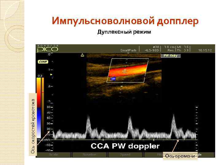 Импульсноволновой допплер Ось скоростей кровотока Дуплексный режим Ось времени 