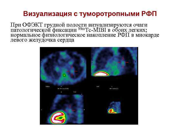 Визуализация с туморотропными РФП При ОФЭКТ грудной полости визуализируются очаги патологической фиксации 99 m.