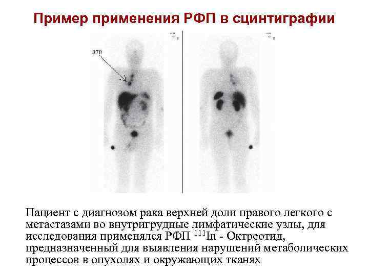Пример применения РФП в сцинтиграфии Пациент с диагнозом рака верхней доли правого легкого с
