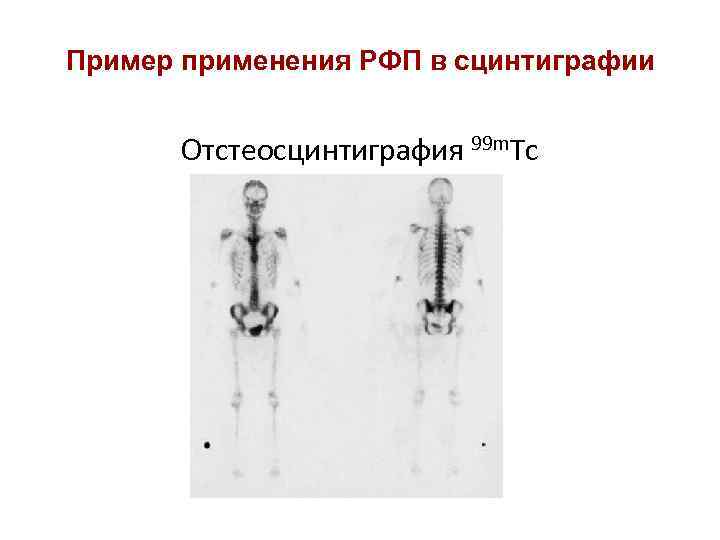Пример применения РФП в сцинтиграфии Отстеосцинтиграфия 99 m. Tc 