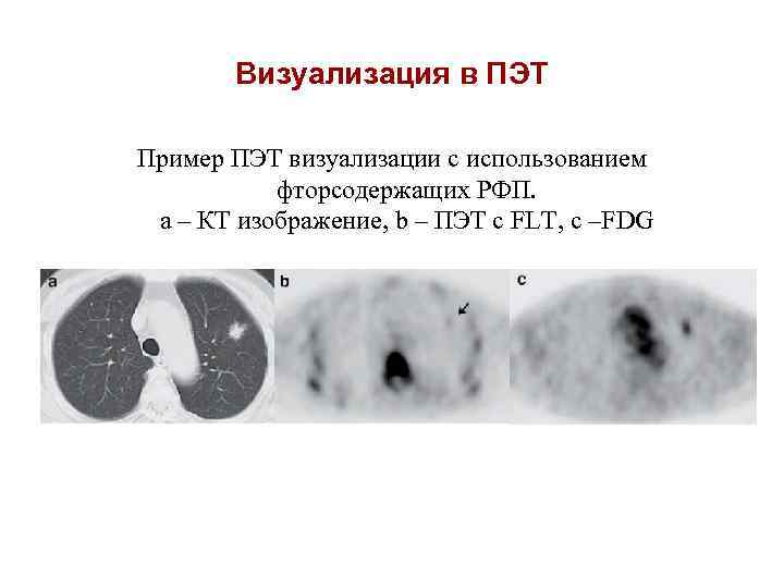Визуализация в ПЭТ Пример ПЭТ визуализации с использованием фторсодержащих РФП. a – КТ изображение,