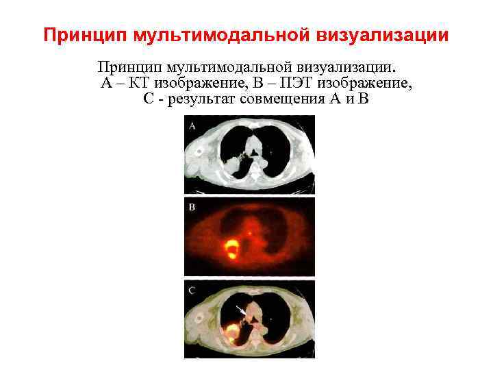 Принцип мультимодальной визуализации. А – КТ изображение, В – ПЭТ изображение, С результат совмещения