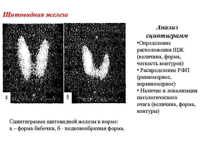 Щитовидная железа Анализ сцинтиграмм • Определение расположения ЩЖ (величина, форма, четкость контуров) • Распределение