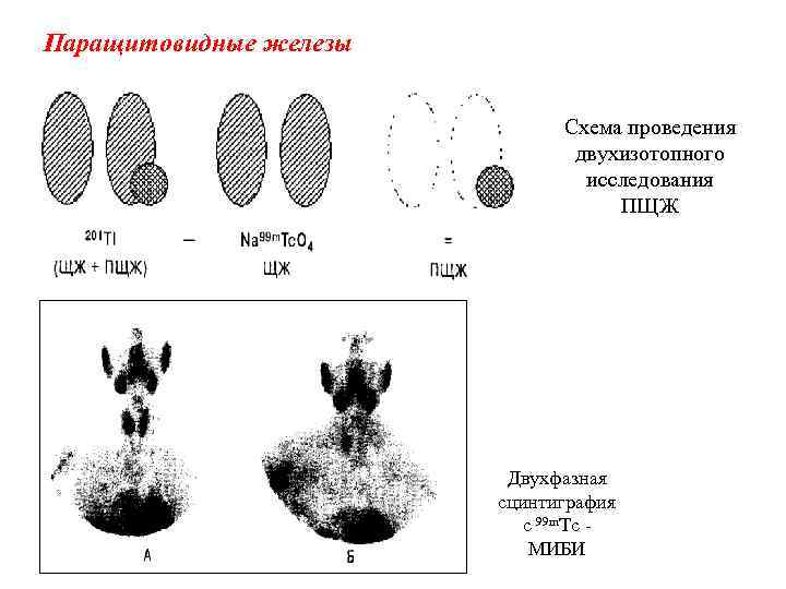 Паращитовидные железы Схема проведения двухизотопного исследования ПЩЖ Двухфазная сцинтиграфия с 99 m. Tс МИБИ