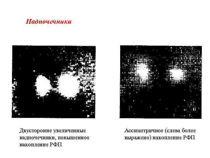 Надпочечники Двусторонне увеличенные надпочечники, повышенное накопление РФП Ассиметричное (слева более выражено) накопление РФП 