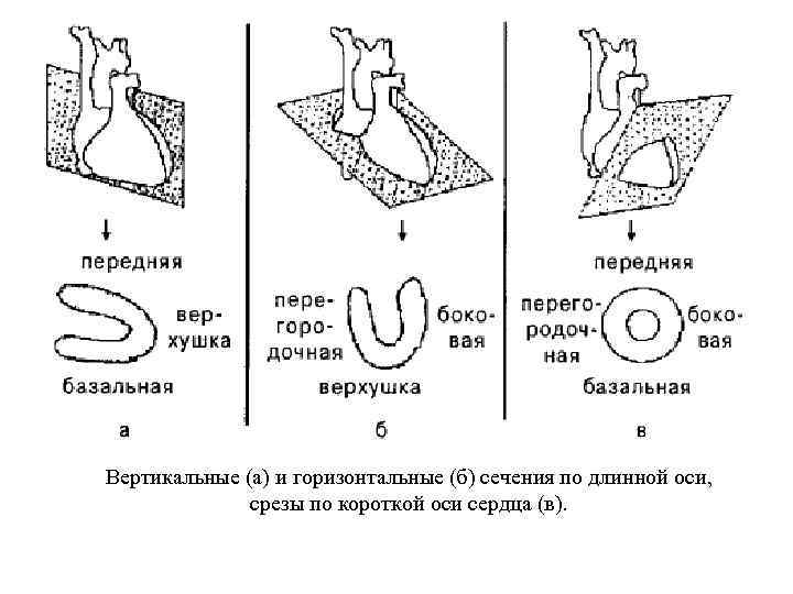Вертикальные (а) и горизонтальные (б) сечения по длинной оси, срезы по короткой оси сердца