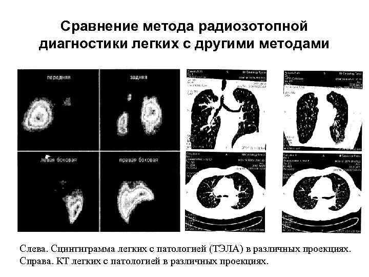 Сравнение метода радиозотопной диагностики легких с другими методами Слева. Сцинтиграмма легких с патологией (ТЭЛА)