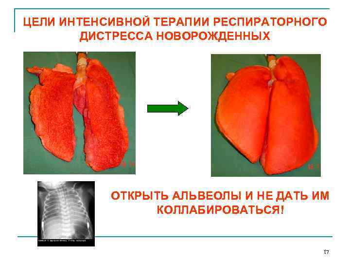 ЦЕЛИ ИНТЕНСИВНОЙ ТЕРАПИИ РЕСПИРАТОРНОГО ДИСТРЕССА НОВОРОЖДЕННЫХ ОТКРЫТЬ АЛЬВЕОЛЫ И НЕ ДАТЬ ИМ КОЛЛАБИРОВАТЬСЯ! 17