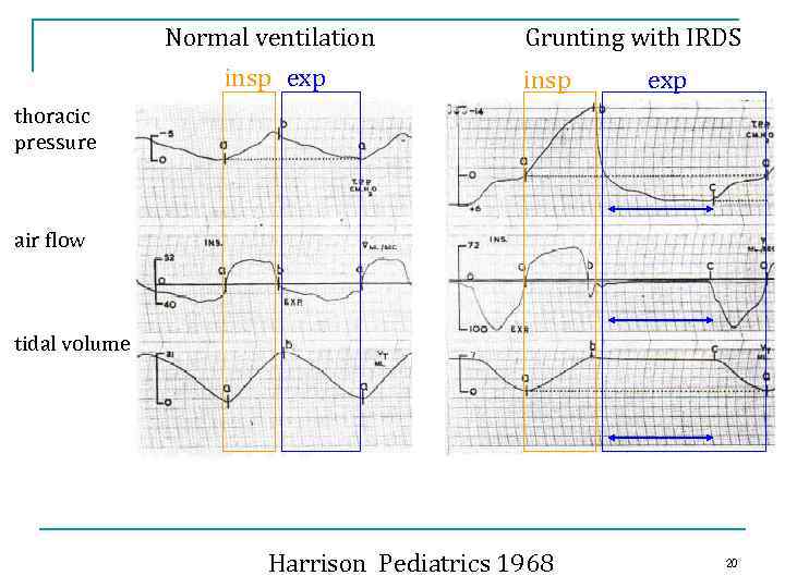 Normal ventilation insp exp Grunting with IRDS insp exp thoracic pressure air flow tidal