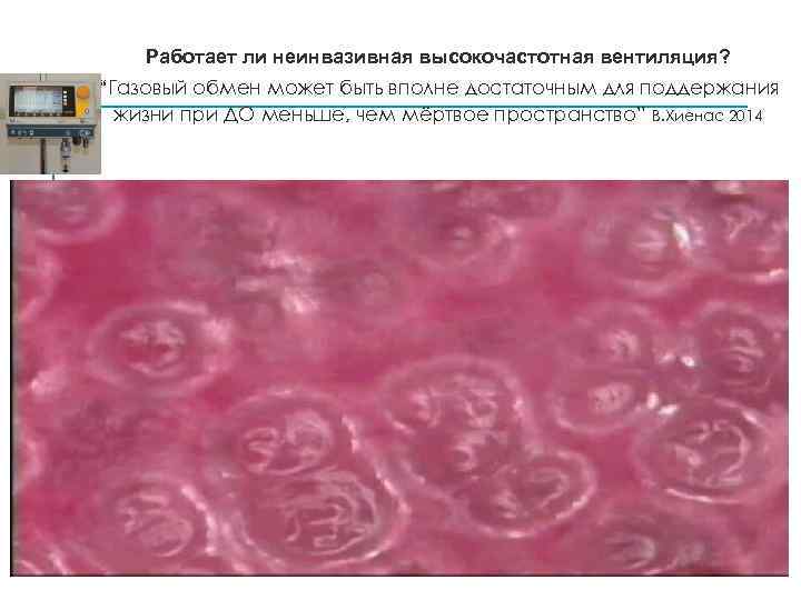 Работает ли неинвазивная высокочастотная вентиляция? “Газовый обмен может быть вполне достаточным для поддержания жизни