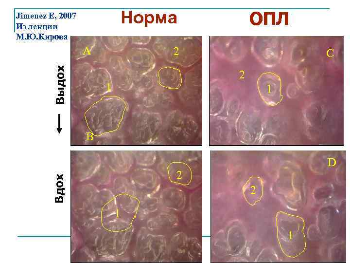 Норма Jimenez E, 2007 Из лекции М. Ю. Кирова Выдох A ОПЛ 2 C