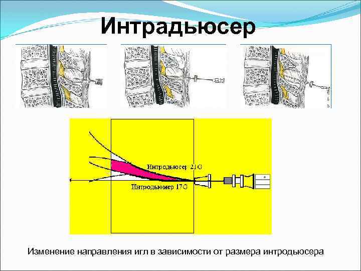 Интрадьюсер Изменение направления игл в зависимости от размера интродьюсера 