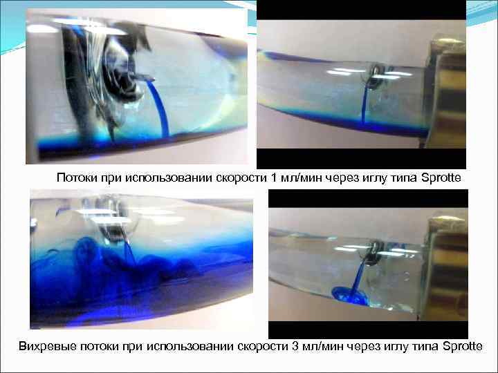 Потоки при использовании скорости 1 мл/мин через иглу типа Sprotte Вихревые потоки при использовании