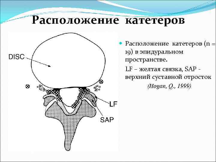 Расположение катетеров (n = 19) в эпидуральном пространстве. LF – желтая связка, SAP -