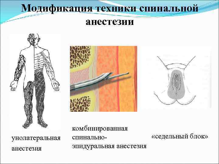 Модификация техники спинальной анестезии унолатеральная анестезия комбинированная «седельный блок» спинальноэпидуральная анестезия 