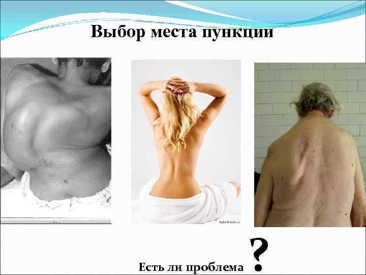 Выбор места пункции Есть ли проблема ? 