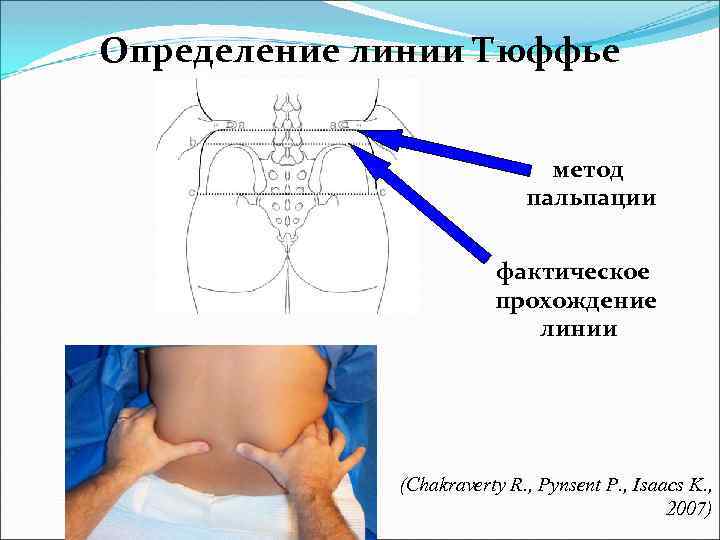 Определение линии Тюффье метод пальпации фактическое прохождение линии (Chakraverty R. , Pynsent P. ,