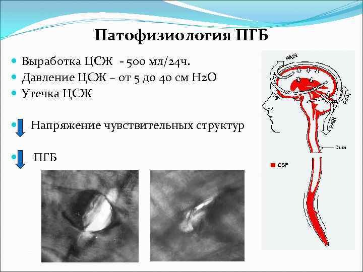 Патофизиология ПГБ Выработка ЦСЖ - 500 мл/24 ч. Давление ЦСЖ – от 5 до
