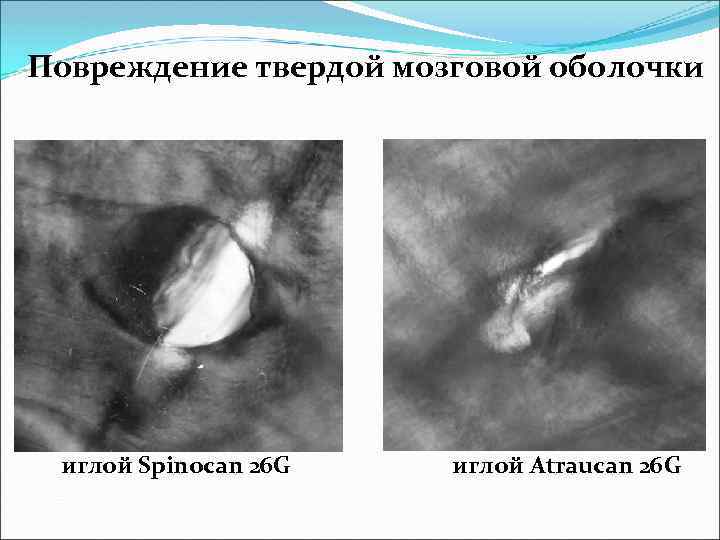 Повреждение твердой мозговой оболочки иглой Spinocan 26 G иглой Atraucan 26 G 