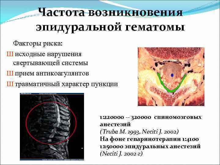Частота возникновения эпидуральной гематомы Факторы риска: Ш исходные нарушения свертывающей системы Ш прием антикоагулянтов