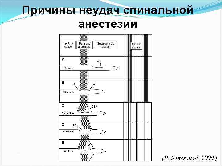Причины неудач спинальной анестезии (P. Fettes et al. 2009 ) 