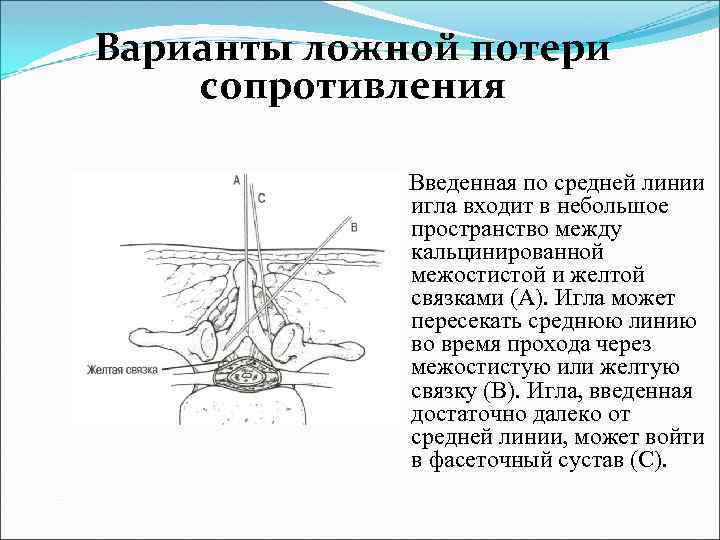 Варианты ложной потери сопротивления Введенная по средней линии игла входит в небольшое пространство между