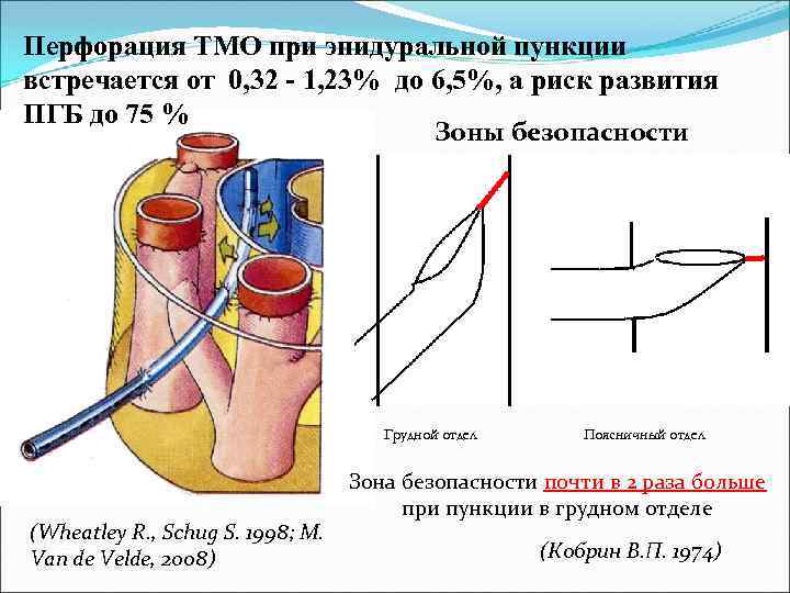 Перфорация ТМО при эпидуральной пункции встречается от 0, 32 - 1, 23% до 6,
