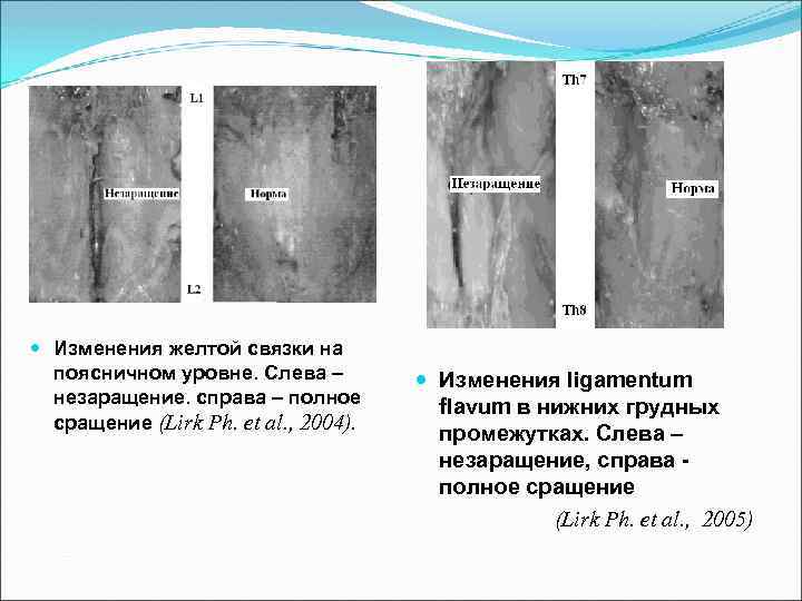  Изменения желтой связки на поясничном уровне. Слева – незаращение. справа – полное сращение