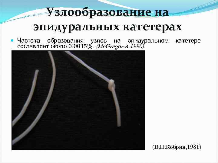  Узлообразование на эпидуральных катетерах Частота образования узлов на эпидуральном катетере составляет около 0,