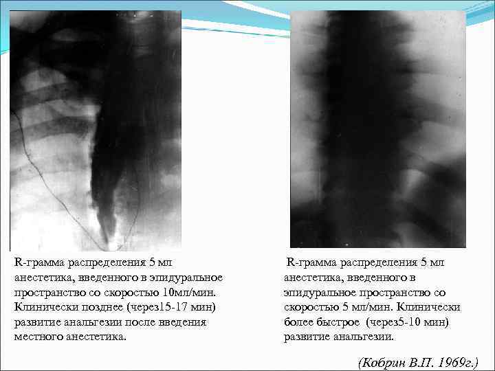 R-грамма распределения 5 мл анестетика, введенного в эпидуральное пространство со скоростью 10 мл/мин. Клинически