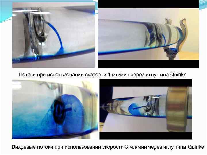 Потоки при использовании скорости 1 мл/мин через иглу типа Quinkе Вихревые потоки при использовании
